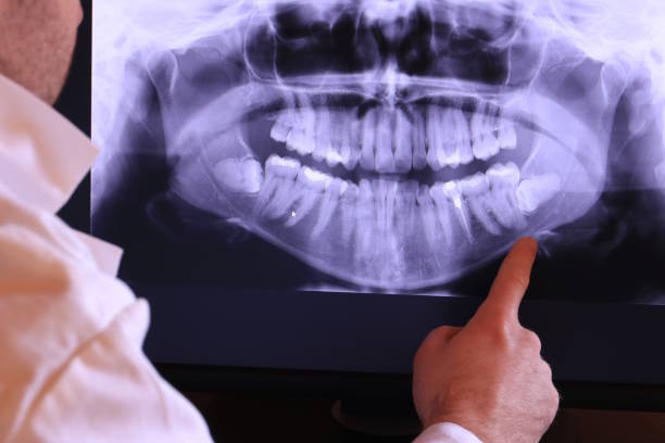 Best Emergency Dental Extractions in Clarksville, IN